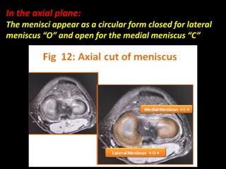 In the axial plane:
The menisci appear as a circular form closed for lateral
meniscus “O” and open for the medial meniscus “C”
 