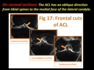 On coronal sections: The ACL has an oblique direction
from tibial spines to the medial face of the lateral condyle.
 