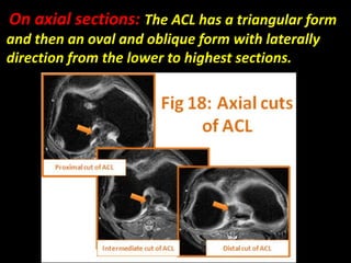 On axial sections: The ACL has a triangular form
and then an oval and oblique form with laterally
direction from the lower to highest sections.
 