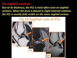 On sagittal sections:
Due to its thickness, the PCL is most often seen on sagittal
sections. When the knee is placed in slight external rotation,
the PCL is usually fully visible on the same sagittal section.
 