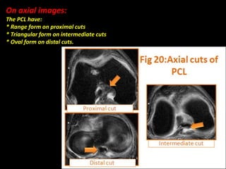 On axial images:
The PCL have:
* Range form on proximal cuts
* Triangular form on intermediate cuts
* Oval form on distal cuts.
 