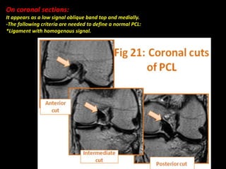 On coronal sections:
It appears as a low signal oblique band top and medially.
-The following criteria are needed to define a normal PCL:
*Ligament with homogenous signal.mogeneous signal.
 