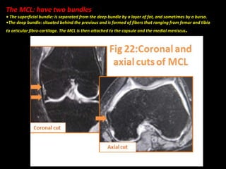The MCL: have two bundles
• The superficial bundle: is separated from the deep bundle by a layer of fat, and sometimes by a bursa.
•The deep bundle: situated behind the previous and is formed of fibers that ranging from femur and tibia
to articular fibro-cartilage. The MCL is then attached to the capsule and the medial meniscus.
 