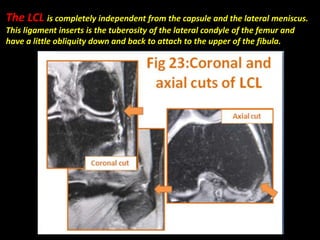 The LCL is completely independent from the capsule and the lateral meniscus.
This ligament inserts is the tuberosity of the lateral condyle of the femur and
have a little obliquity down and back to attach to the upper of the fibula.
 
