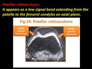 Patellar retinaculums:
It appears as a low signal band extending from the
patella to the femoral condyles on axial plane.
 
