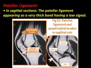Patellar Ligament:
• In sagittal sections: The patellar ligament
appearing as a very thick band having a low signal.
 
