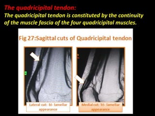 The quadricipital tendon:
The quadricipital tendon is constituted by the continuity
of the muscle fascia of the four quadricipital muscles.
 