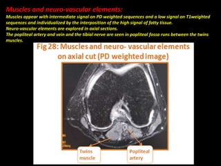 Muscles and neuro-vascular elements:
Muscles appear with intermediate signal on PD weighted sequences and a low signal on T1weighted
sequences and individualized by the interposition of the high signal of fatty tissue.
Neuro-vascular elements are explored in axial sections.
The popliteal artery and vein and the tibial nerve are seen in popliteal fossa runs between the twins
muscles.
 