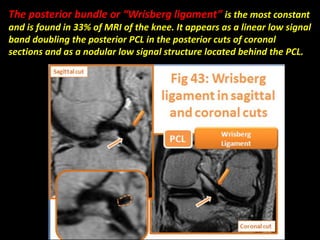 The posterior bundle or “Wrisberg ligament” is the most constant
and is found in 33% of MRI of the knee. It appears as a linear low signal
band doubling the posterior PCL in the posterior cuts of coronal
sections and as a nodular low signal structure located behind the PCL.
 