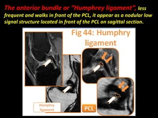 The anterior bundle or “Humphrey ligament”, less
frequent and walks in front of the PCL, it appear as a nodular low
signal structure located in front of the PCL on sagittal section.
 