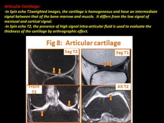 Articular Cartilage:
-In Spin echo T1weighted images, the cartilage is homogeneous and have an intermediate
signal between that of the bone marrow and muscle. It differs from the low signal of
meniscal and cortical signal.
-In Spin echo T2, the presence of high signal intra-articular fluid is used to evaluate the
thickness of the cartilage by arthrographic effect.
 