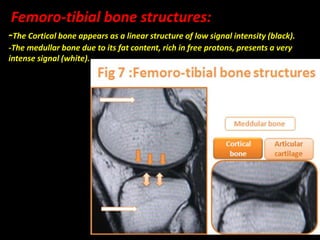 Femoro-tibial bone structures:
-The Cortical bone appears as a linear structure of low signal intensity (black).
-The medullar bone due to its fat content, rich in free protons, presents a very
intense signal (white).
 