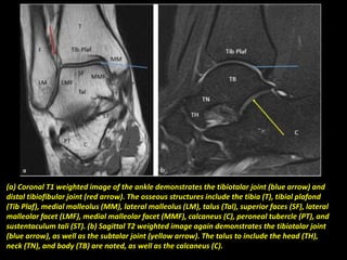 (a) Coronal T1 weighted image of the ankle demonstrates the tibiotalar joint (blue arrow) and
distal tibiofibular joint (red arrow). The osseous structures include the tibia (T), tibial plafond
(Tib Plaf), medial malleolus (MM), lateral malleolus (LM), talus (Tal), superior faces (SF), lateral
malleolar facet (LMF), medial malleolar facet (MMF), calcaneus (C), peroneal tubercle (PT), and
sustentaculum tali (ST). (b) Sagittal T2 weighted image again demonstrates the tibiotalar joint
(blue arrow), as well as the subtalar joint (yellow arrow). The talus to include the head (TH),
neck (TN), and body (TB) are noted, as well as the calcaneus (C).
 