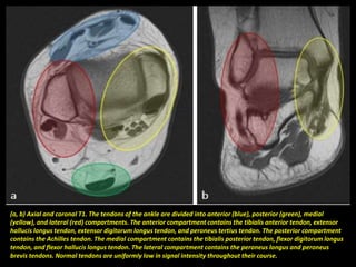 (a, b) Axial and coronal T1. The tendons of the ankle are divided into anterior (blue), posterior (green), medial
(yellow), and lateral (red) compartments. The anterior compartment contains the tibialis anterior tendon, extensor
hallucis longus tendon, extensor digitorum longus tendon, and peroneus tertius tendon. The posterior compartment
contains the Achilles tendon. The medial compartment contains the tibialis posterior tendon, flexor digitorum longus
tendon, and flexor hallucis longus tendon. The lateral compartment contains the peroneus longus and peroneus
brevis tendons. Normal tendons are uniformly low in signal intensity throughout their course.
 