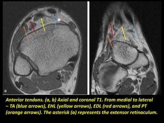 Anterior tendons. (a, b) Axial and coronal T1. From medial to lateral
– TA (blue arrows), EHL (yellow arrows), EDL (red arrows), and PT
(orange arrows). The asterisk (a) represents the extensor retinaculum.
 