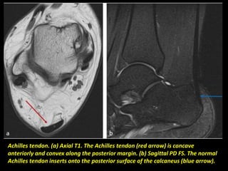 Achilles tendon. (a) Axial T1. The Achilles tendon (red arrow) is concave
anteriorly and convex along the posterior margin. (b) Sagittal PD FS. The normal
Achilles tendon inserts onto the posterior surface of the calcaneus (blue arrow).
 