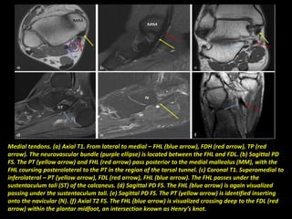 Medial tendons. (a) Axial T1. From lateral to medial – FHL (blue arrow), FDH (red arrow), TP (red
arrow). The neurovascular bundle (purple ellipse) is located between the FHL and FDL. (b) Sagittal PD
FS. The PT (yellow arrow) and FHL (red arrow) pass posterior to the medial malleolus (MM), with the
FHL coursing posterolateral to the PT in the region of the tarsal tunnel. (c) Coronal T1. Superomedial to
inferolateral – PT (yellow arrow), FDL (red arrow), FHL (blue arrow). The FHL passes under the
sustentaculum tali (ST) of the calcaneus. (d) Sagittal PD FS. The FHL (blue arrow) is again visualized
passing under the sustentaculum tali. (e) Sagittal PD FS. The PT (yellow arrow) is identified inserting
onto the navicular (N). (f) Axial T2 FS. The FHL (blue arrow) is visualized crossing deep to the FDL (red
arrow) within the plantar midfoot, an intersection known as Henry’s knot.
 