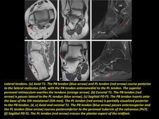 Lateral tendons. (a) Axial T1. The PB tendon (blue arrow) and PL tendon (red arrow) course posterior
to the lateral malleolus (LM), with the PB tendon anteromedial to the PL tendon. The superior
peroneal retinaculum overlies the tendons (orange arrow). (b) Coronal T1. The PB tendon (red
arrow) is passes lateral to the PL tendon (blue arrow). (c) Sagittal PD FS. The PB tendon inserts onto
the base of the 5th metatarsal (5th met). The PL tendon (red arrow) is partially visualized posterior
to the PB tendon. (d, e) Axial and coronal T1. The PB tendon (blue arrow) passes anterosuperior and
the PL tendon (blue arrow) courses posteroinferior to the peroneal tubercle of the calcaneus (PeT).
(f) Sagittal PD FS. The PL tendon (red arrow) crosses the plantar aspect of the midfoot.
 