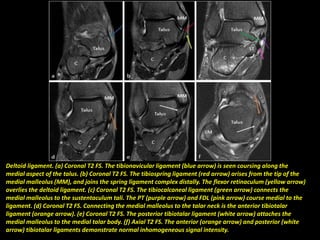 Deltoid ligament. (a) Coronal T2 FS. The tibionavicular ligament (blue arrow) is seen coursing along the
medial aspect of the talus. (b) Coronal T2 FS. The tibiospring ligament (red arrow) arises from the tip of the
medial malleolus (MM), and joins the spring ligament complex distally. The flexor retinaculum (yellow arrow)
overlies the deltoid ligament. (c) Coronal T2 FS. The tibiocalcaneal ligament (green arrow) connects the
medial malleolus to the sustentaculum tali. The PT (purple arrow) and FDL (pink arrow) course medial to the
ligament. (d) Coronal T2 FS. Connecting the medial malleolus to the talar neck is the anterior tibiotalar
ligament (orange arrow). (e) Coronal T2 FS. The posterior tibiotalar ligament (white arrow) attaches the
medial malleolus to the medial talar body. (f) Axial T2 FS. The anterior (orange arrow) and posterior (white
arrow) tibiotalar ligaments demonstrate normal inhomogeneous signal intensity.
 