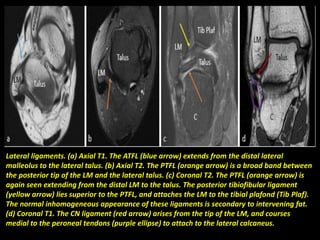 Lateral ligaments. (a) Axial T1. The ATFL (blue arrow) extends from the distal lateral
malleolus to the lateral talus. (b) Axial T2. The PTFL (orange arrow) is a broad band between
the posterior tip of the LM and the lateral talus. (c) Coronal T2. The PTFL (orange arrow) is
again seen extending from the distal LM to the talus. The posterior tibiofibular ligament
(yellow arrow) lies superior to the PTFL, and attaches the LM to the tibial plafond (Tib Plaf).
The normal inhomogeneous appearance of these ligaments is secondary to intervening fat.
(d) Coronal T1. The CN ligament (red arrow) arises from the tip of the LM, and courses
medial to the peroneal tendons (purple ellipse) to attach to the lateral calcaneus.
 