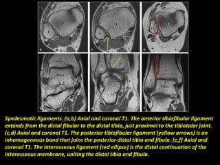 Syndesmotic ligaments. (a,b) Axial and coronal T1. The anterior tibiofibular ligament
extends from the distal fibular to the distal tibia, just proximal to the tibiotalar joint.
(c,d) Axial and coronal T1. The posterior tibiofibular ligament (yellow arrows) is an
inhomogeneous band that joins the posterior distal tibia and fibula. (e,f) Axial and
coronal T1. The interosseous ligament (red ellipse) is the distal continuation of the
interosseous membrane, uniting the distal tibia and fibula.
 