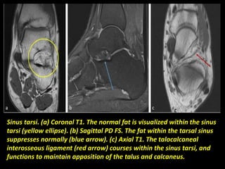 Sinus tarsi. (a) Coronal T1. The normal fat is visualized within the sinus
tarsi (yellow ellipse). (b) Sagittal PD FS. The fat within the tarsal sinus
suppresses normally (blue arrow). (c) Axial T1. The talocalcaneal
interosseous ligament (red arrow) courses within the sinus tarsi, and
functions to maintain apposition of the talus and calcaneus.
 
