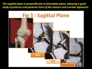 The sagittal plane is perpendicular to bicondylar plane, allowing a good
study of anterior and posterior horn of the menisci and cruciate ligaments.
 