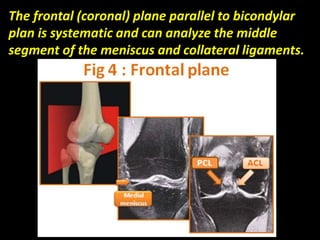 The frontal (coronal) plane parallel to bicondylar
plan is systematic and can analyze the middle
segment of the meniscus and collateral ligaments.
 