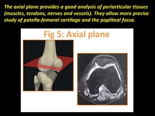 The axial plane provides a good analysis of periarticular tissues
(muscles, tendons, nerves and vessels). They allow more precise
study of patella-femoral cartilage and the popliteal fossa.
 