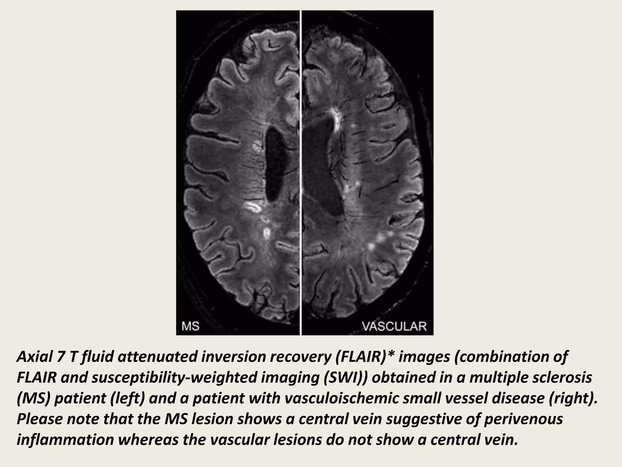 Axial 7 T fluid attenuated inversion recovery (FLAIR)* images (combination of
FLAIR and susceptibility-weighted imaging (SWI)) obtained in a multiple sclerosis
(MS) patient (left) and a patient with vasculoischemic small vessel disease (right).
Please note that the MS lesion shows a central vein suggestive of perivenous
inflammation whereas the vascular lesions do not show a central vein.
 