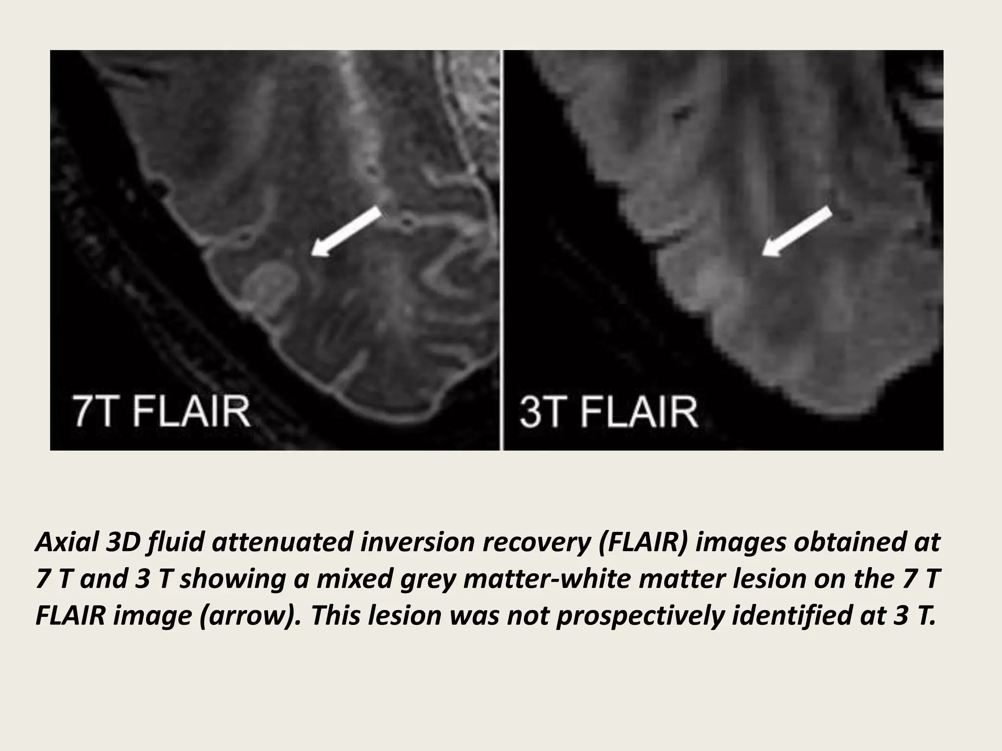 Axial 3D fluid attenuated inversion recovery (FLAIR) images obtained at
7 T and 3 T showing a mixed grey matter-white matter lesion on the 7 T
FLAIR image (arrow). This lesion was not prospectively identified at 3 T.
 