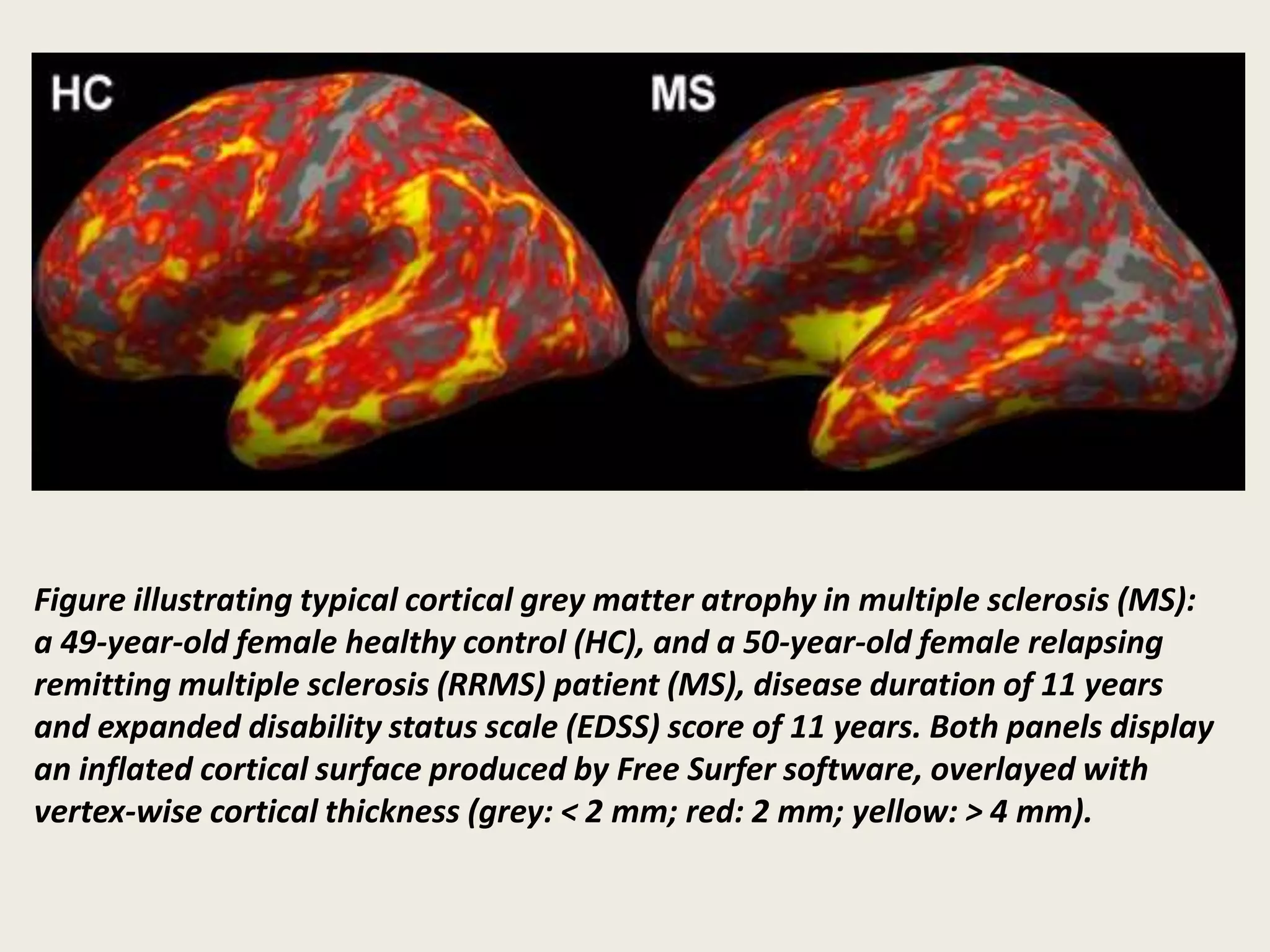 Figure illustrating typical cortical grey matter atrophy in multiple sclerosis (MS):
a 49-year-old female healthy control (HC), and a 50-year-old female relapsing
remitting multiple sclerosis (RRMS) patient (MS), disease duration of 11 years
and expanded disability status scale (EDSS) score of 11 years. Both panels display
an inflated cortical surface produced by Free Surfer software, overlayed with
vertex-wise cortical thickness (grey: < 2 mm; red: 2 mm; yellow: > 4 mm).
 
