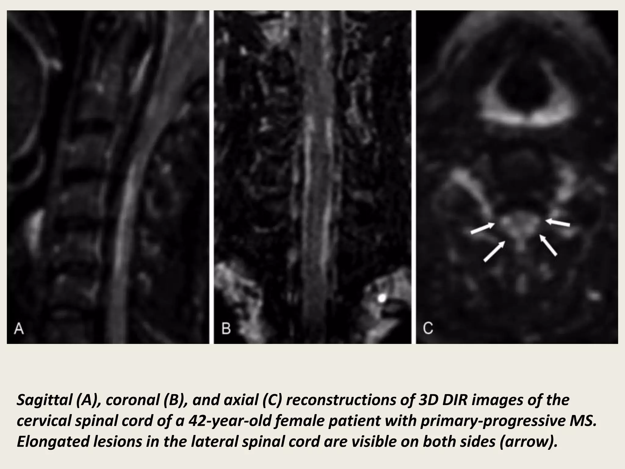 Sagittal (A), coronal (B), and axial (C) reconstructions of 3D DIR images of the
cervical spinal cord of a 42-year-old female patient with primary-progressive MS.
Elongated lesions in the lateral spinal cord are visible on both sides (arrow).
 