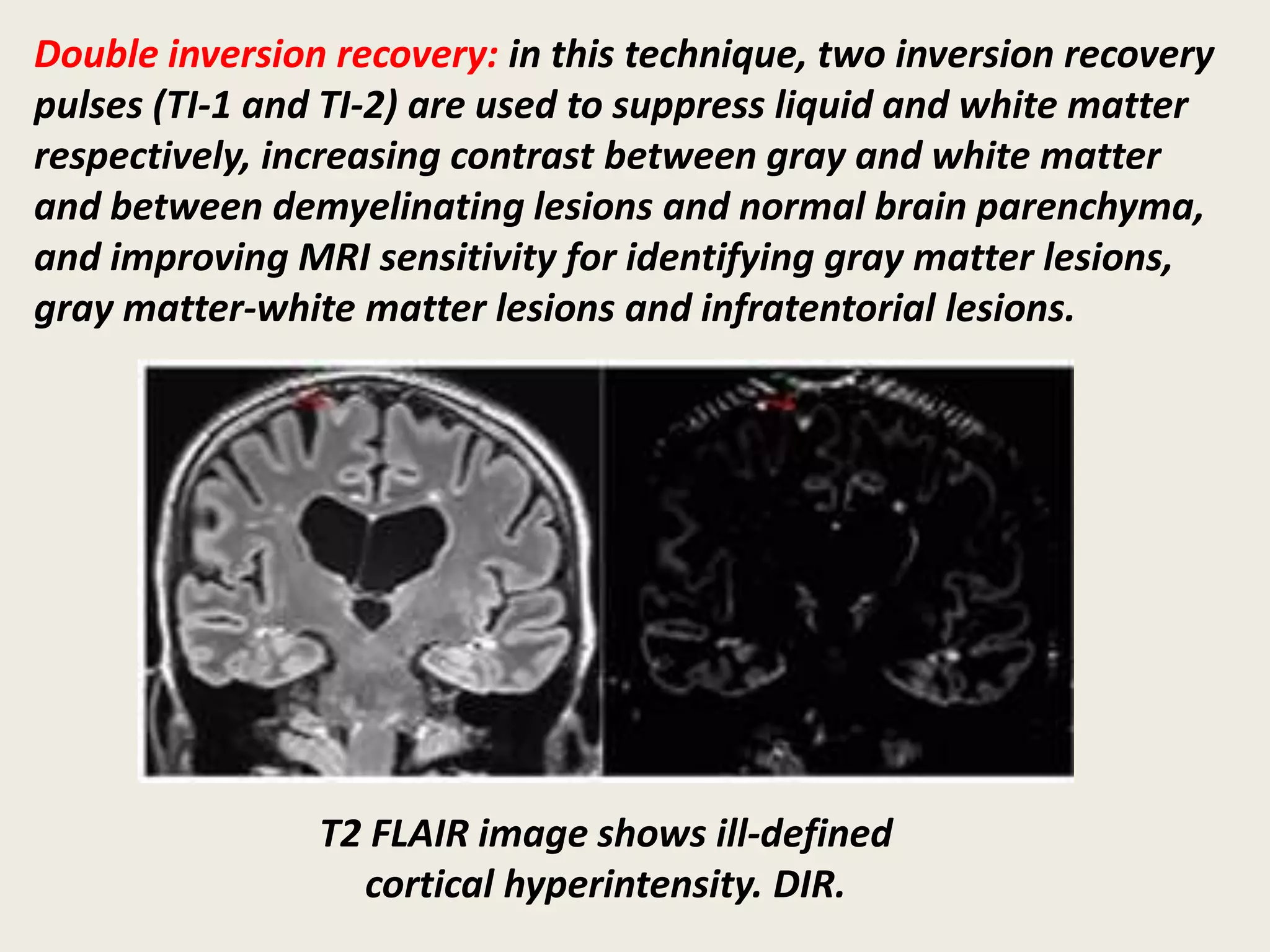 Double inversion recovery: in this technique, two inversion recovery
pulses (TI-1 and TI-2) are used to suppress liquid and white matter
respectively, increasing contrast between gray and white matter
and between demyelinating lesions and normal brain parenchyma,
and improving MRI sensitivity for identifying gray matter lesions,
gray matter-white matter lesions and infratentorial lesions.
T2 FLAIR image shows ill-defined
cortical hyperintensity. DIR.
 