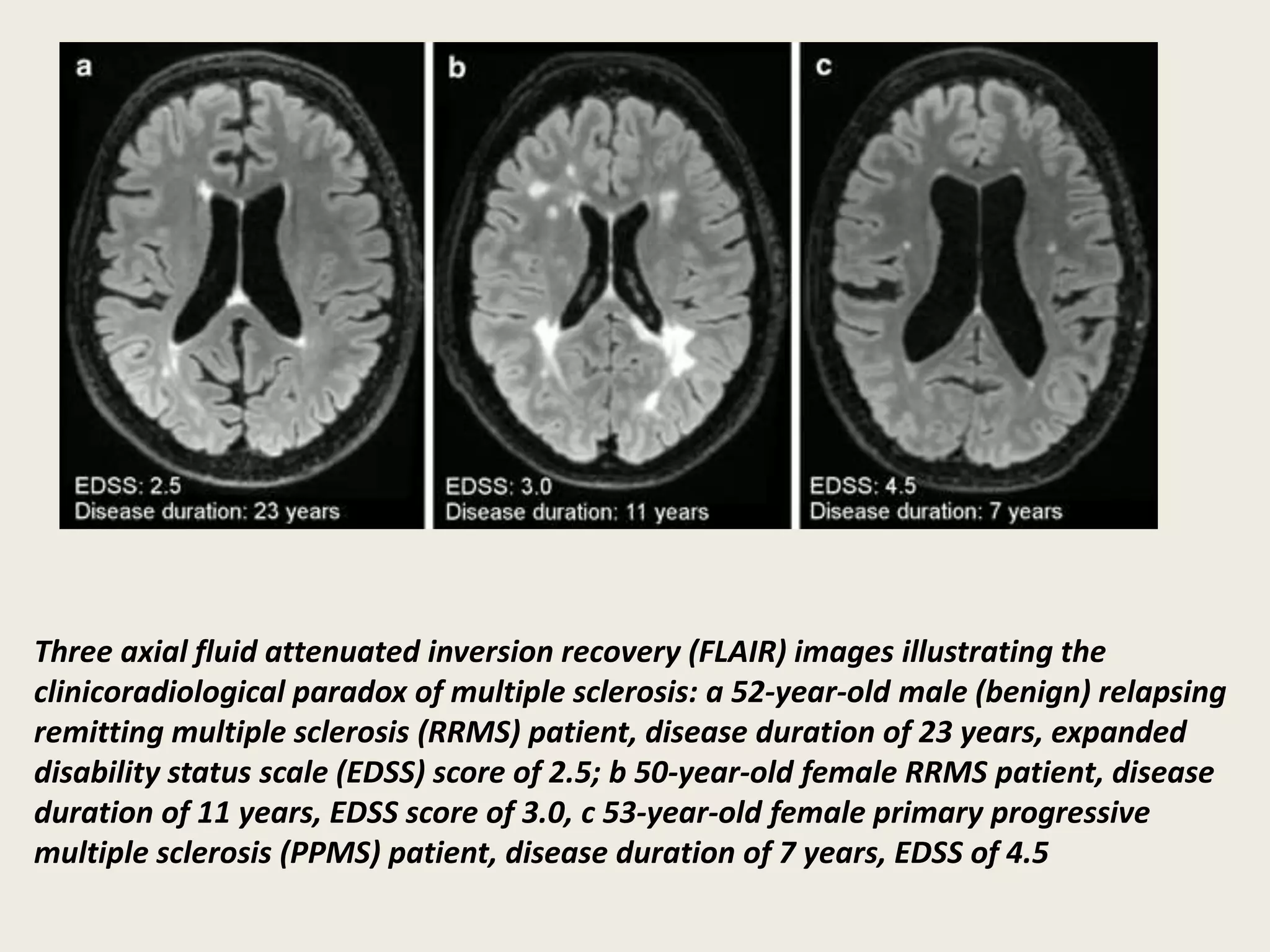 Three axial fluid attenuated inversion recovery (FLAIR) images illustrating the
clinicoradiological paradox of multiple sclerosis: a 52-year-old male (benign) relapsing
remitting multiple sclerosis (RRMS) patient, disease duration of 23 years, expanded
disability status scale (EDSS) score of 2.5; b 50-year-old female RRMS patient, disease
duration of 11 years, EDSS score of 3.0, c 53-year-old female primary progressive
multiple sclerosis (PPMS) patient, disease duration of 7 years, EDSS of 4.5
 