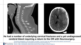1
He had a number of underlying cervical fractures and a yet undiagnosed
cerebral bleed requiring a return to the OR with Neurosurgery.
The above photograph is not from Dylan’s accident. It and his case are used as part of this didactic reconstruction.
Source: https://radiopaedia.org/articles/cervical-spine-fractures?lang=us
Source: https://radiopaedia.org/articles/cerebral-haemorrhagic-contusion?lang=us
 