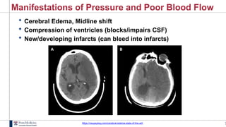 3
Manifestations of Pressure and Poor Blood Flow
 Cerebral Edema, Midline shift
 Compression of ventricles (blocks/impairs CSF)
 New/developing infarcts (can bleed into infarcts)
https://neupsykey.com/cerebral-edema-state-of-the-art/
 