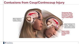 3
Contusions from Coup/Contrecoup Injury
 