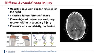 4
Diffuse Axonal/Shear Injury
 Usually occur with sudden rotation of
the head
 Shearing forces “stretch” axons
 If axon injured but not severed, may
recover without secondary injury
 Presents with impulsivity, confusion
https://radiopaedia.org/cases/diffuse-axonal-injury-3?lang=gb
 