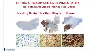 4
CHRONIC TRAUMATIC ENCEPHALOPATHY
Tau Protein: Amygdala (McKee et al. 2009)
Healthy Brain Football Player Boxer
 