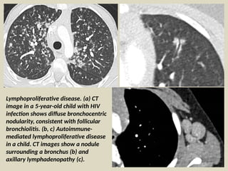 Comprehensive Imaging and Diagnosis of Pediatric and Adult Interstitial ...