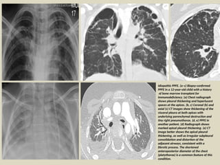 Ppfe Examples Comprehensive Imaging and Diagnosis of Pediatric and Adult Interstitial ...