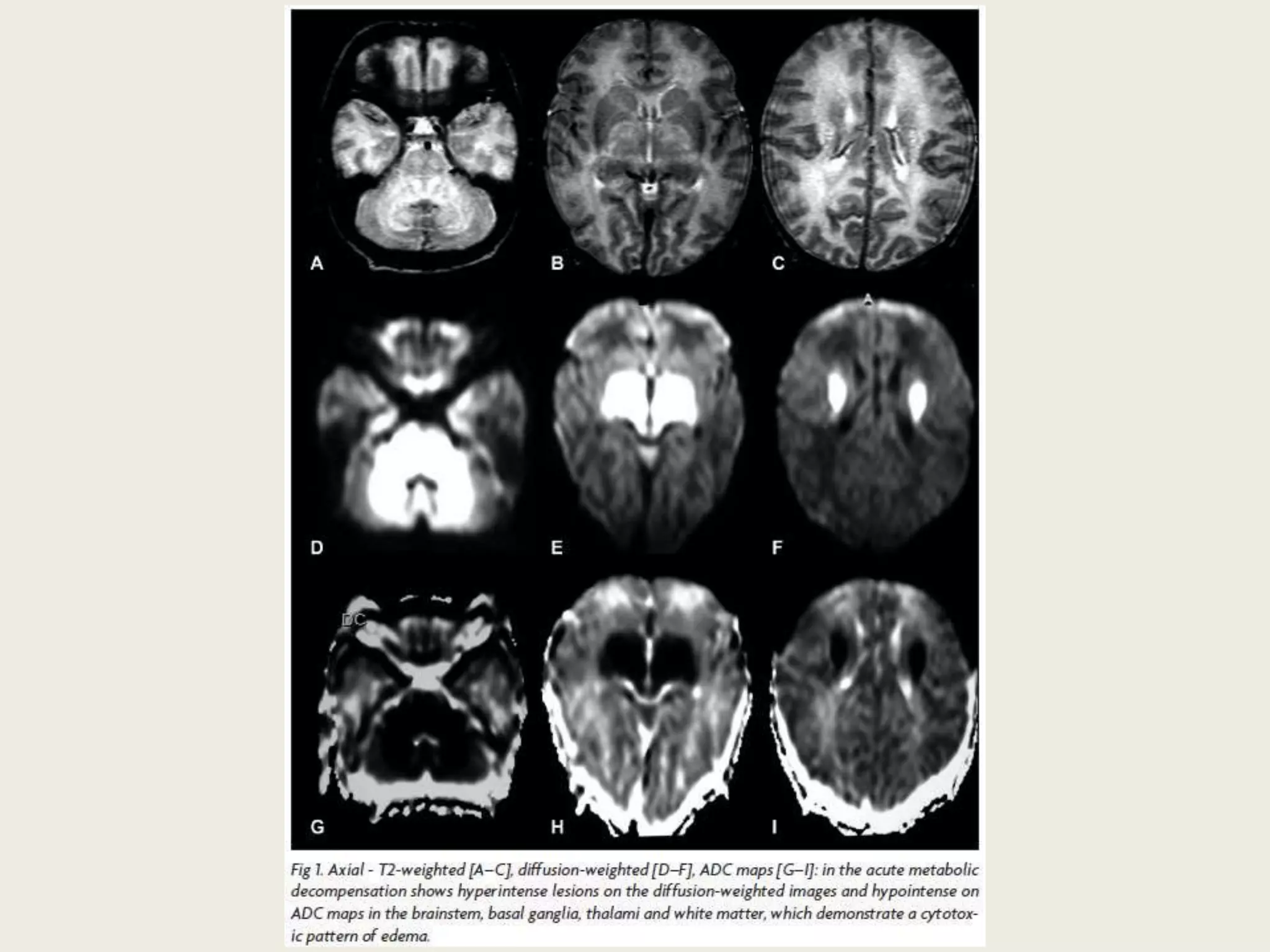 Presentation1, radiological application of diffusion weighted imges in ...