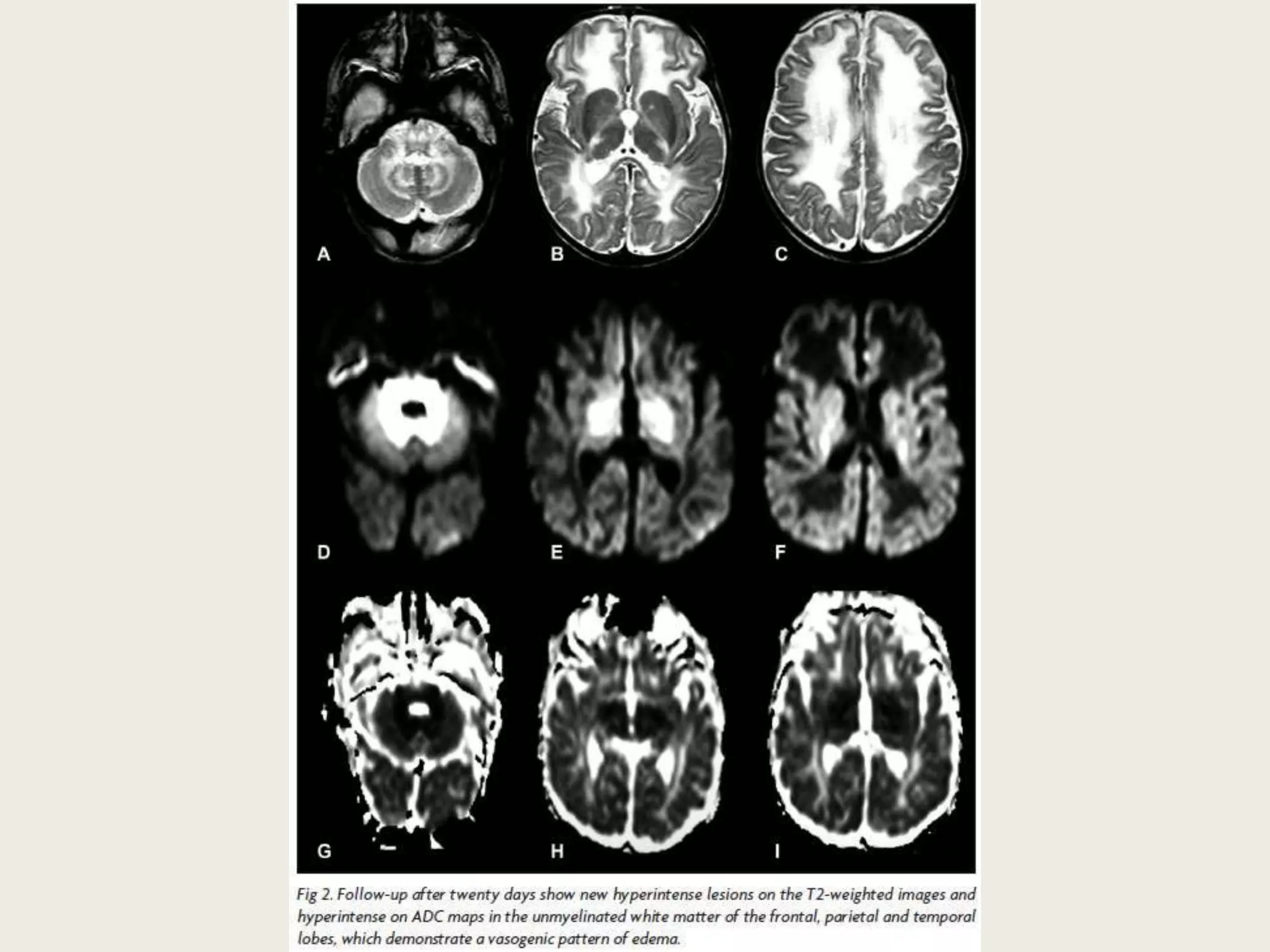 Presentation1, radiological application of diffusion weighted imges in ...