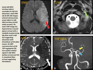 Ica Infarct Presentation1, radiological application of diffusion weighted imges in ...