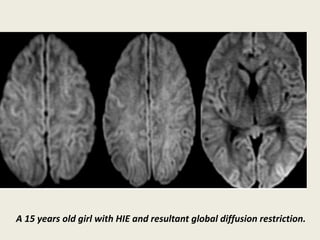 Presentation1, radiological application of diffusion weighted imges in ...