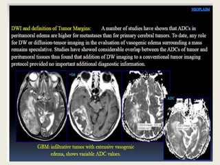 Presentation1, radiological application of diffusion weighted imges in ...