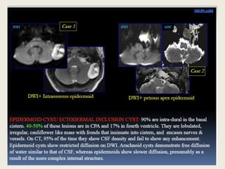 Presentation1, radiological application of diffusion weighted imges in ...
