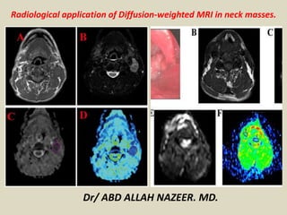 Radiological application of Diffusion-weighted MRI in neck masses.
Dr/ ABD ALLAH NAZEER. MD.
 