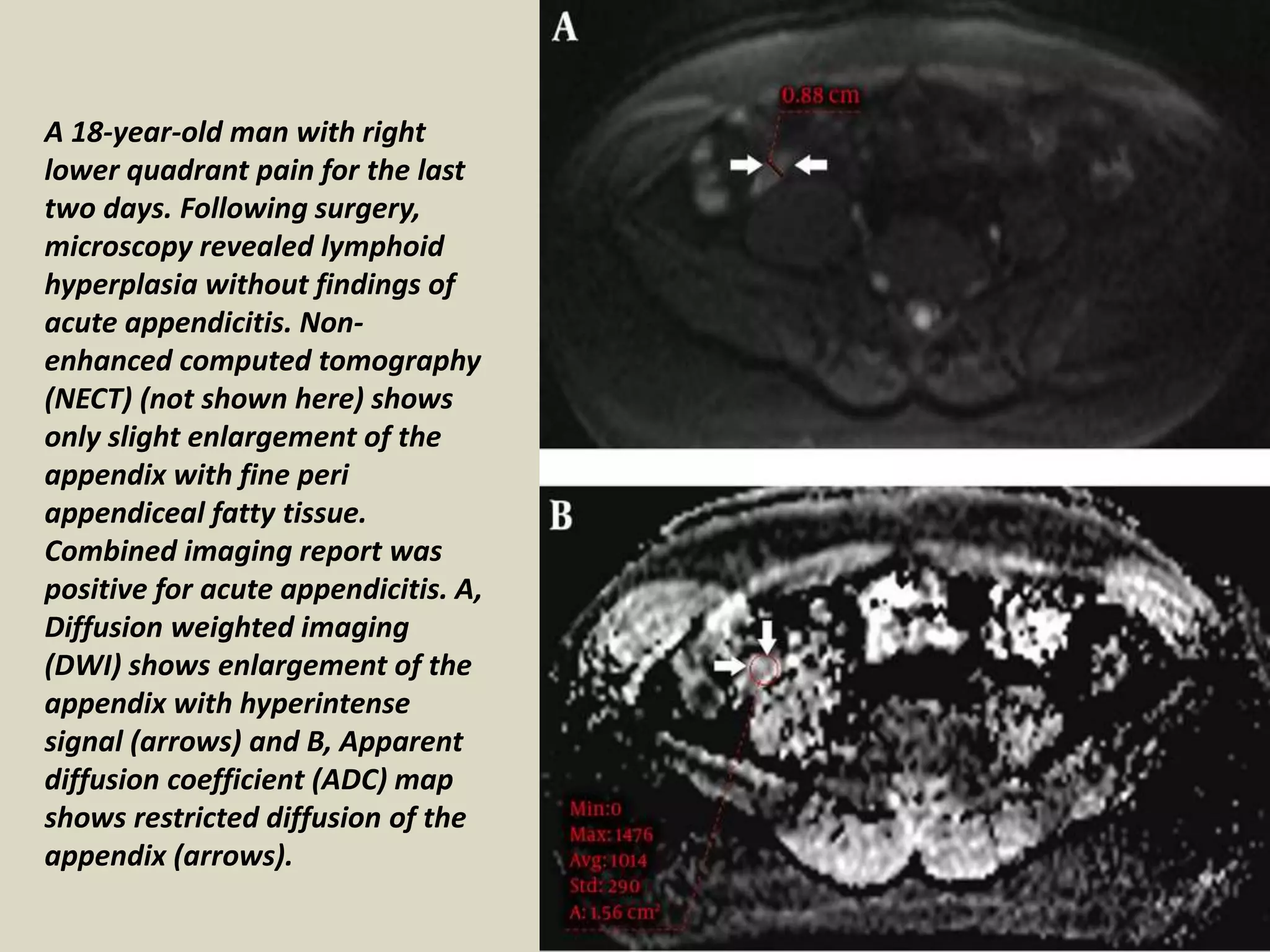 Presentation1, radiological application of diffusion weighted images in ...